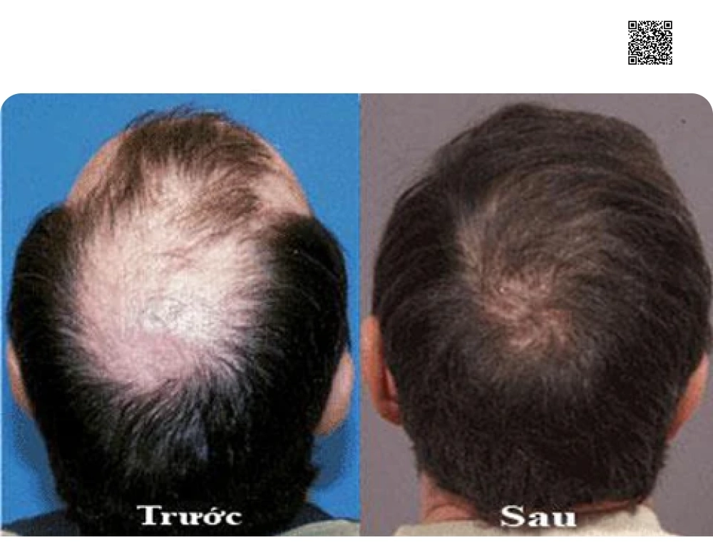 Viên Uống Mọc Tóc EXCELLENT HAIR Cao Cấp USA
